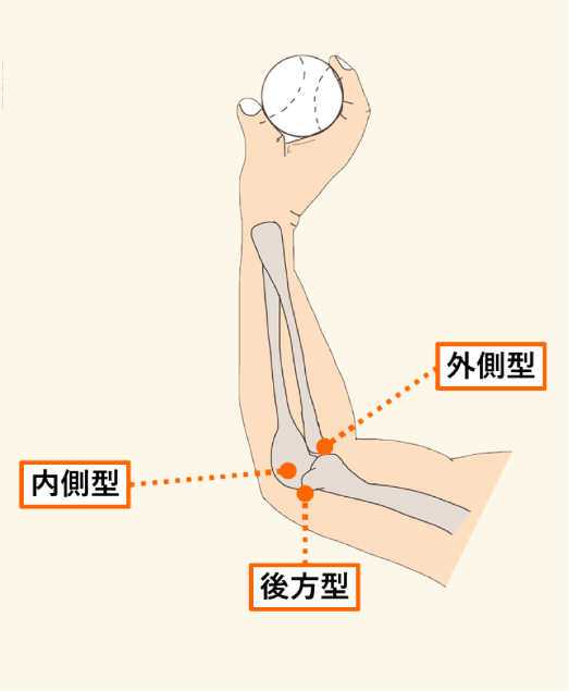 外側型、内側型、後方型