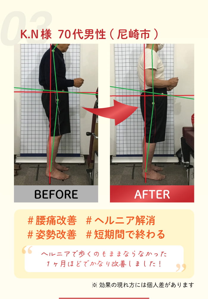 03:K. N 様 70 代男性(尼崎市) #腰痛改善 #ヘルニア解消 #姿勢改善 #短期間で終わる。ヘルニアで歩くのもままならなかったが7ヶ月はどでかなり改善しました!