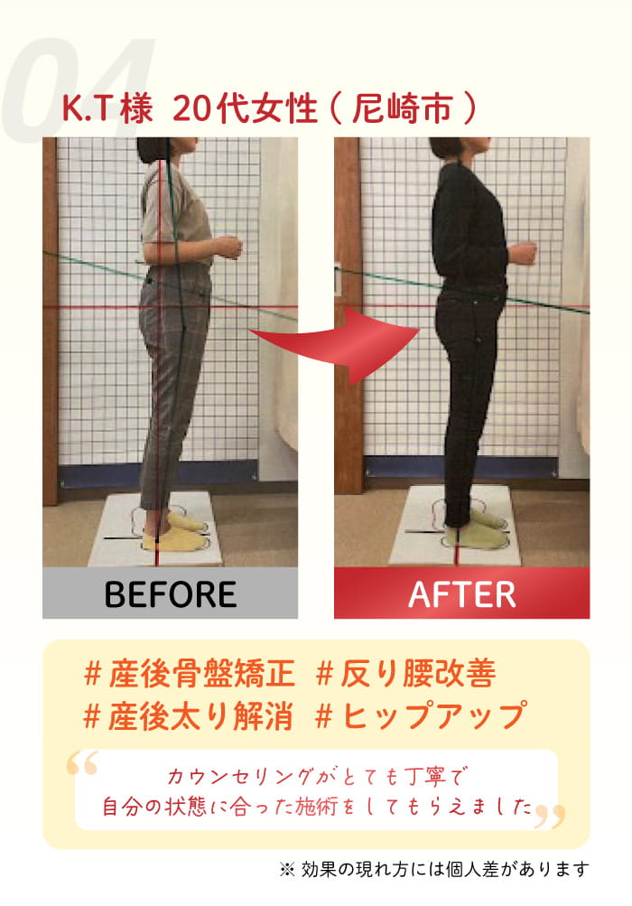04:K. T 様 20 代女性(尼崎市) #産後骨盤矯正 #反り腰改善。#産後太り解消 #ヒップアップ カウンセリングが、とても丁寧て。自分の状態は合った施術をしてもリえました!
